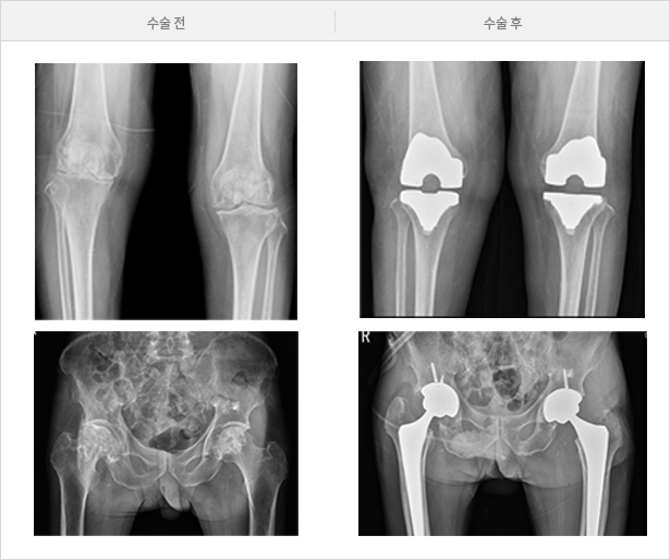 관절수술전후 엑스레이사진 비교