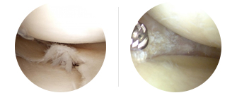 파열증상과 관절내시경을 이용한 봉합수술 이미지