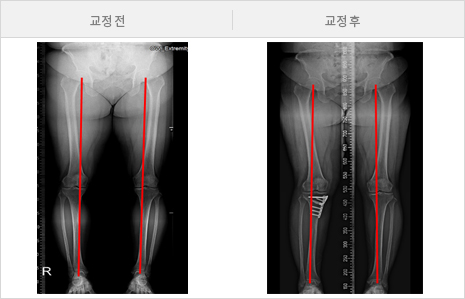 휜다리교정 전 후 사진비교