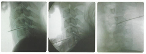 경추 수핵 감압술 적응대상쪽 사진으로 엑스레이에 보여주는 사진